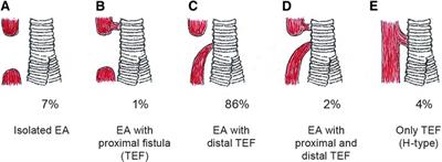 Establishment of a condition-specific quality-of-life questionnaire for children born with esophageal atresia aged 2–7 across 14 countries